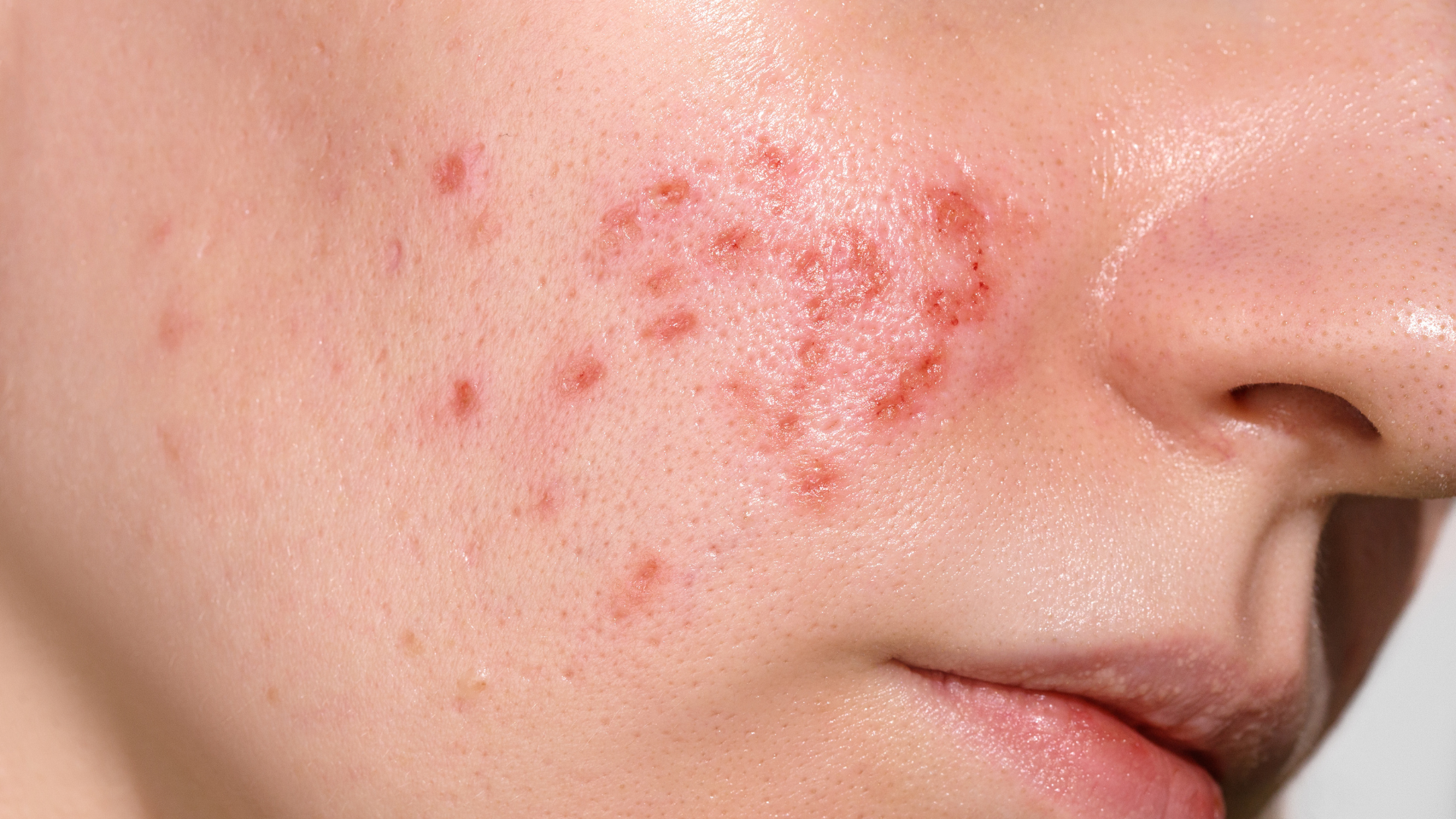 Gợi ý cách làm xẹp mụn sưng đỏ sau 1 đêm an toàn tại nhà