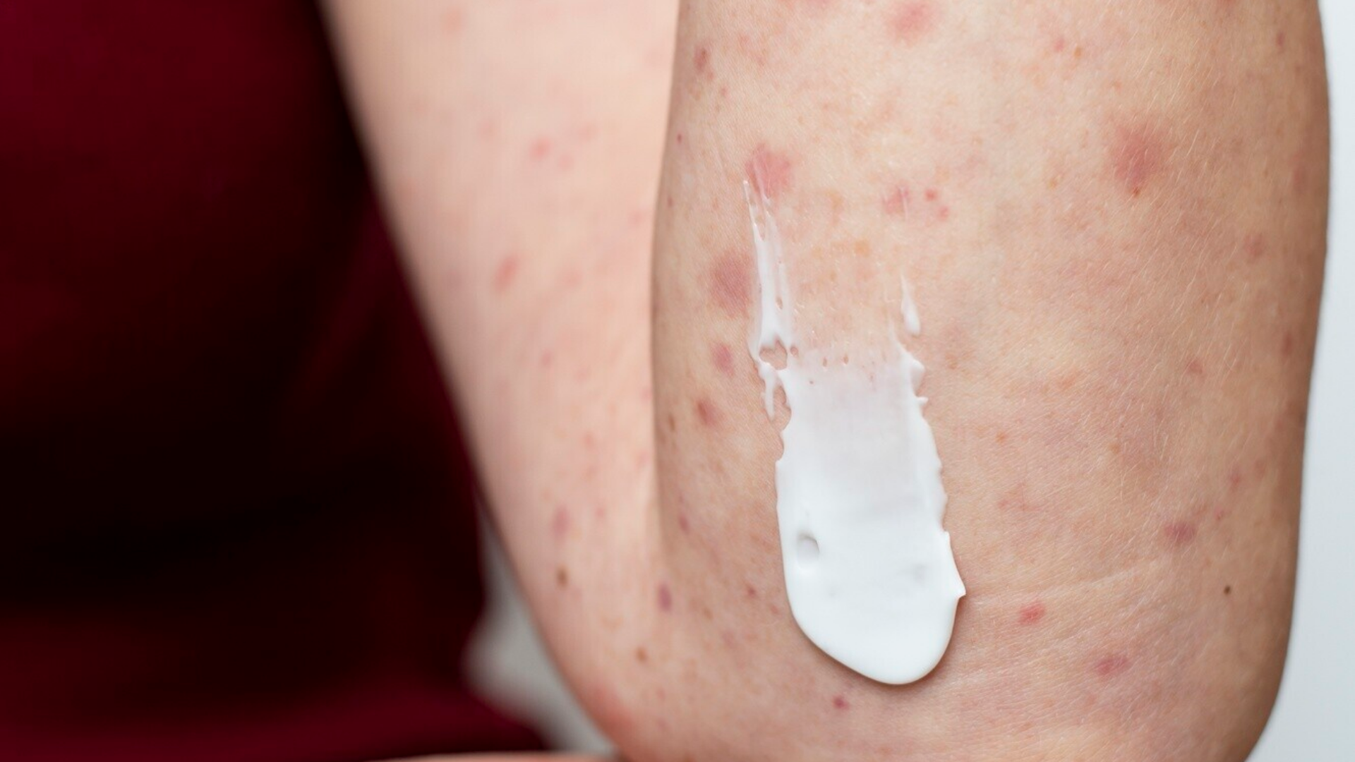 Cách nhận biết 7 dấu hiệu nhiễm HIV ban đầu ở nam giới 2