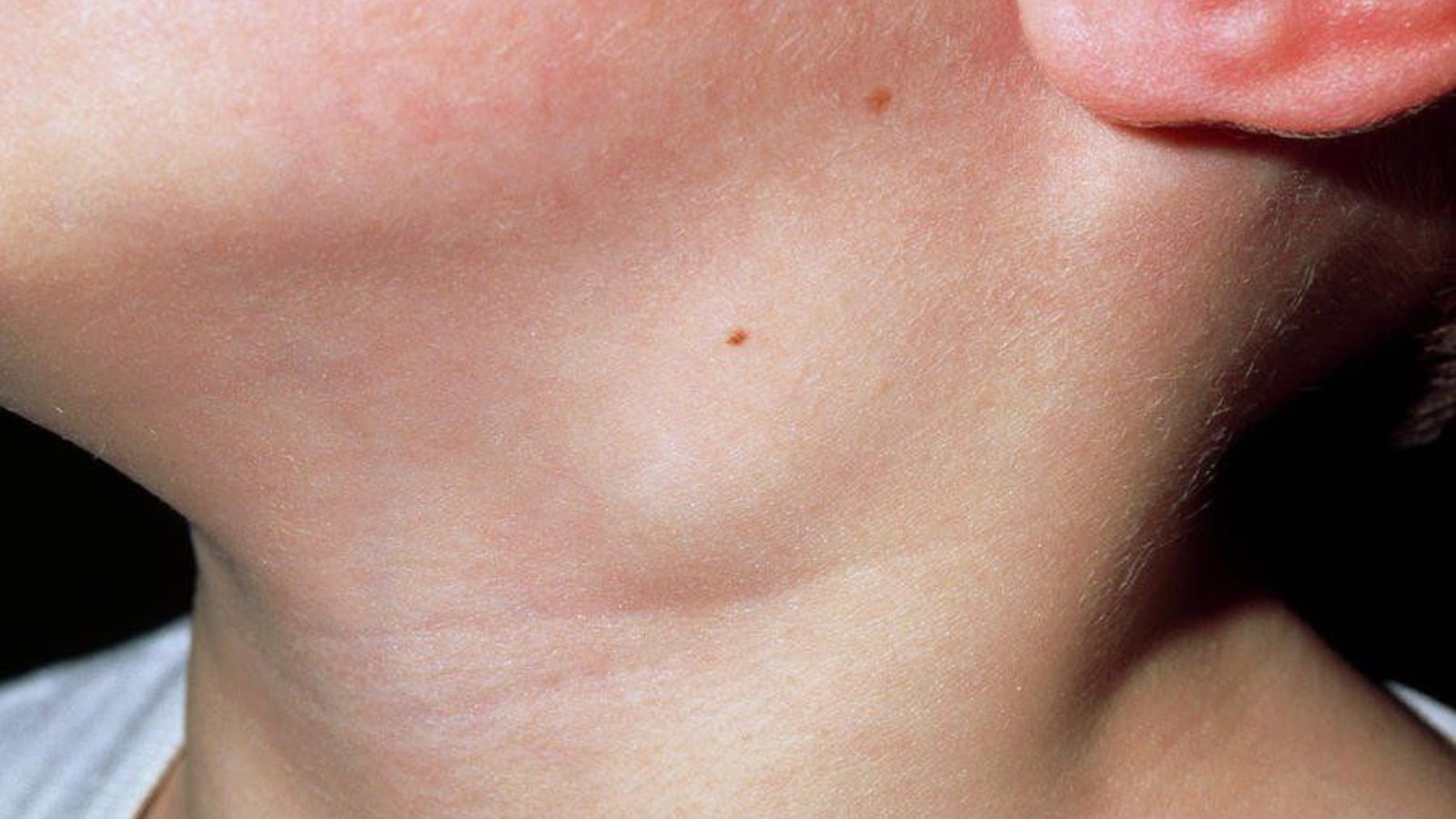 Cách nhận biết sưng hạch bạch huyết là vấn đề được nhiều người quan tâm