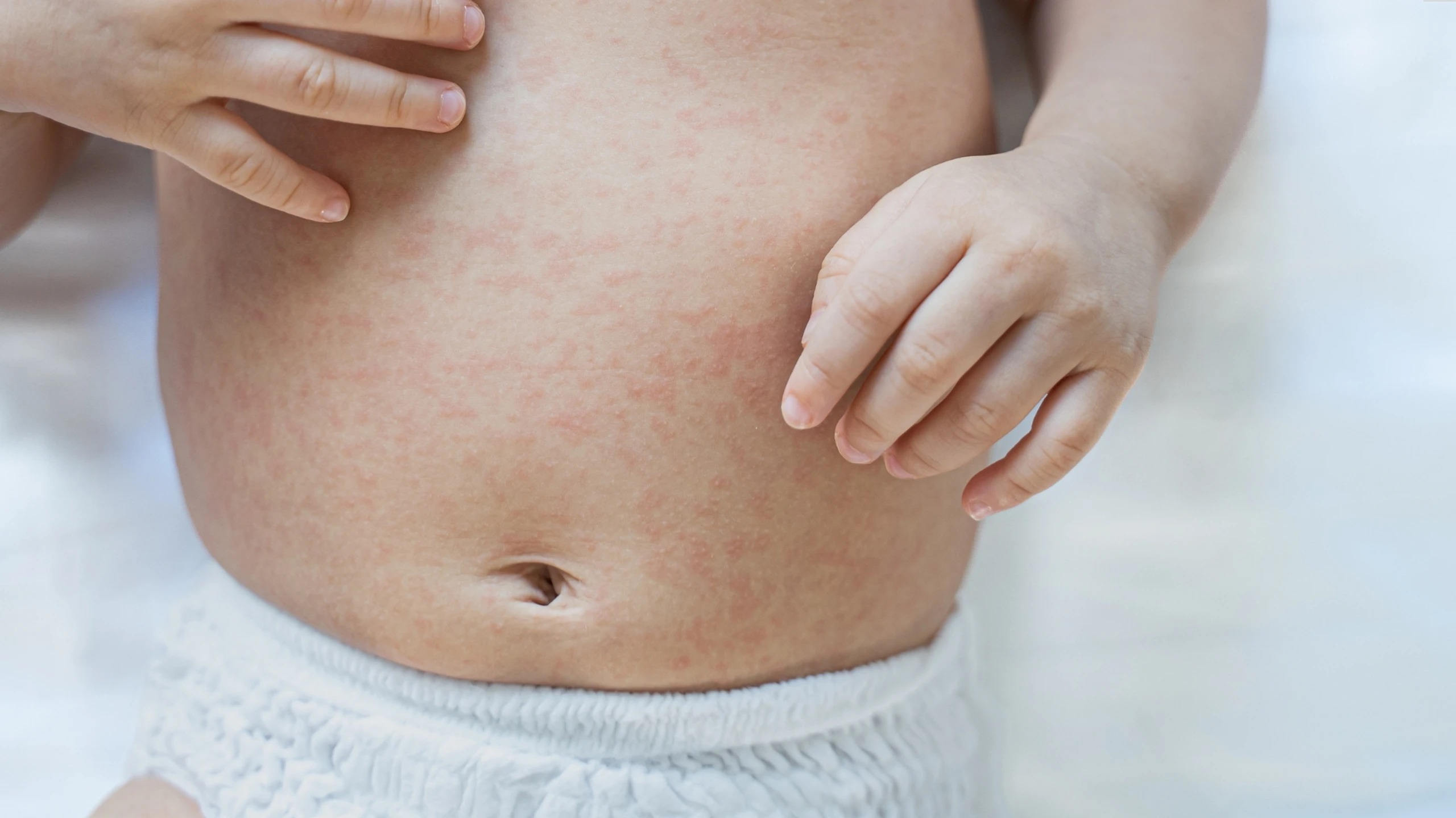 Sốt phát ban thường xuất hiện thành từng mảng hoặc rải rác