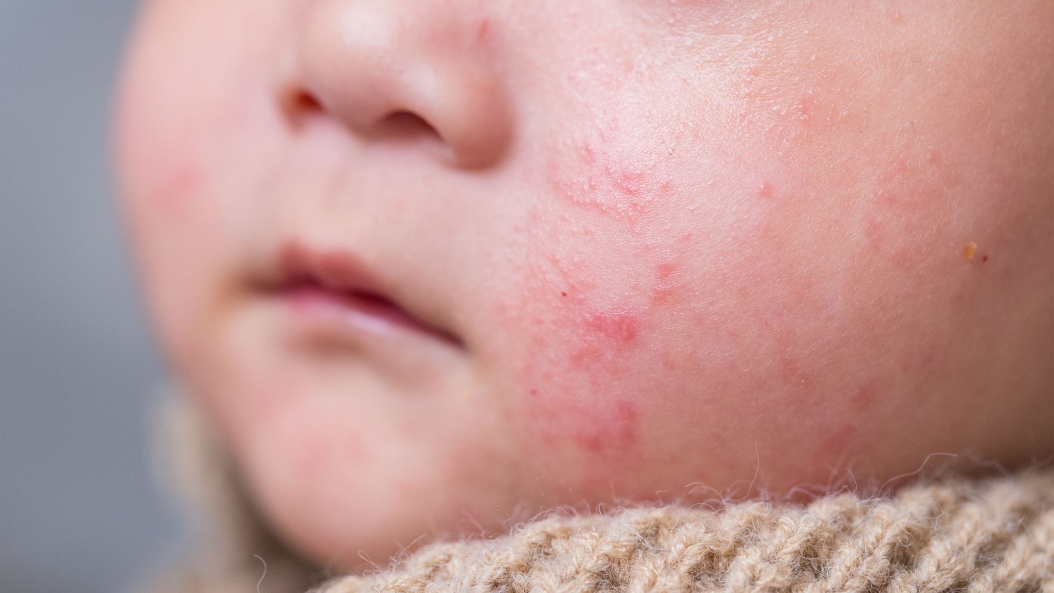 Hạn chế cho trẻ tiếp xúc với người đang có biểu hiện sốt, phát ban hoặc nhiễm virus để phòng ngừa sốt phát ban