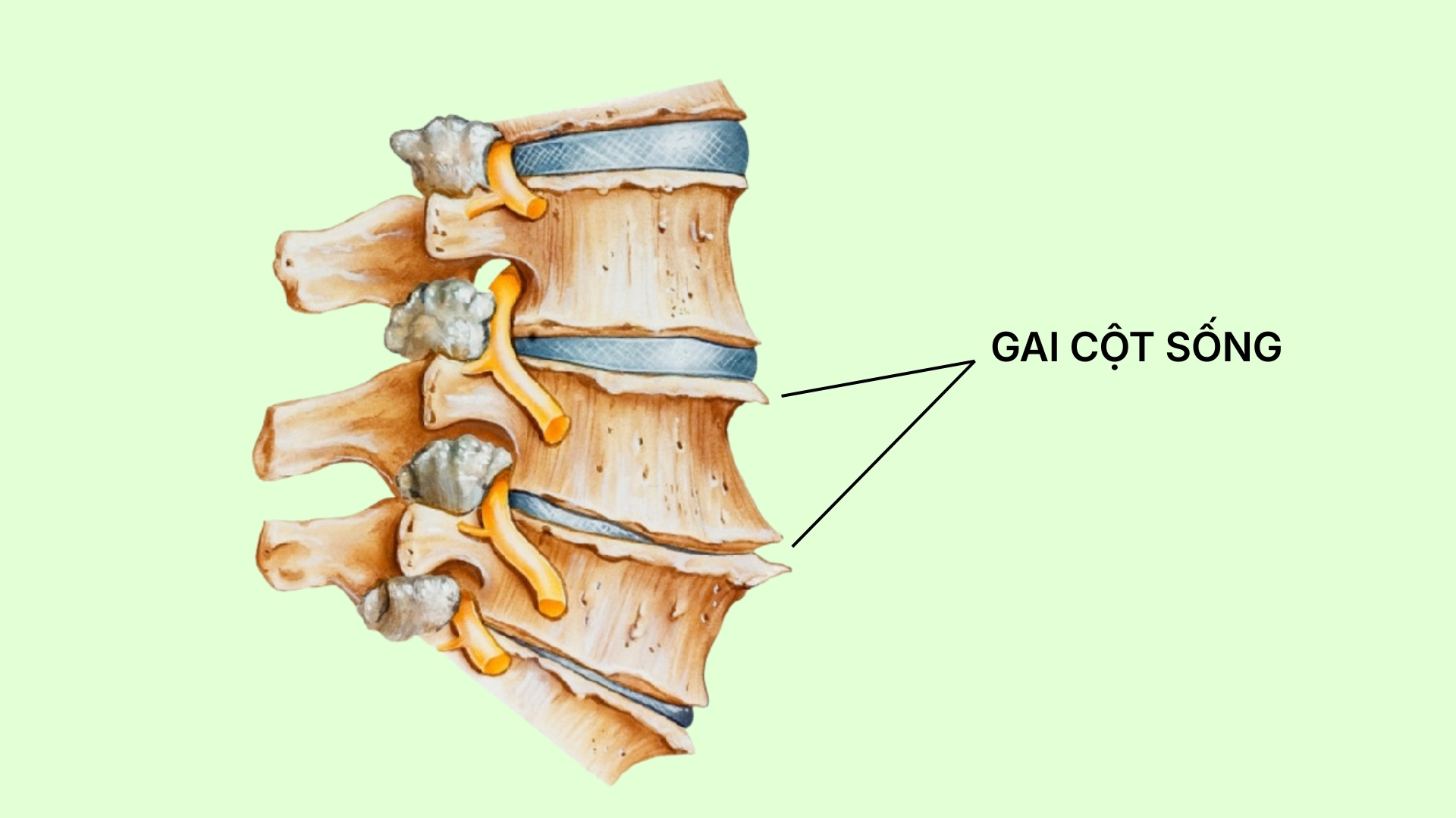 Gai cột sống là tình trạng xuất hiện các mấu xương bất thường phát triển thêm ra từ thân đốt sống hoặc các khớp của cột sống