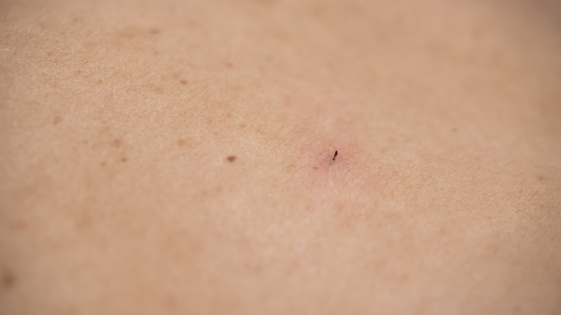 cach-tri-mun-coc​ 02.png