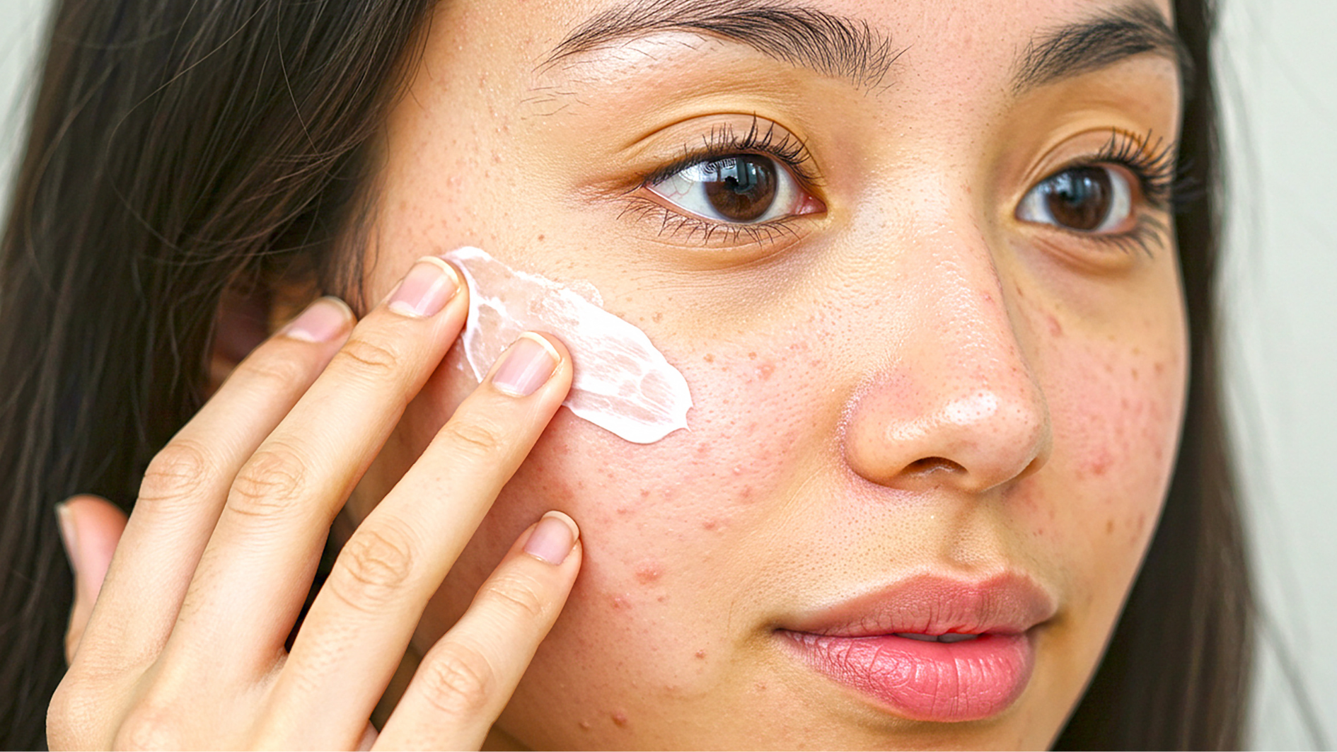 Sử dụng Salicylic Acid là cách trị mụn đầu đen ở mũi