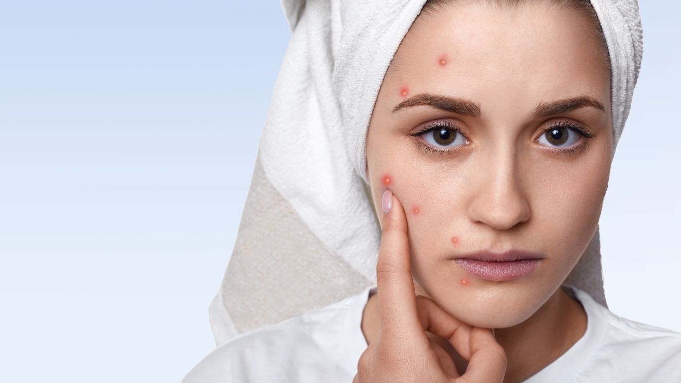 Cách trị mụn nội tiết hiệu quả và an toàn 1