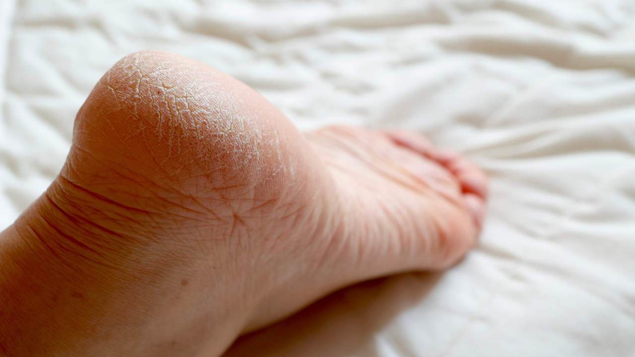 Dùng bột gạo, mật ong và giấm để làm mềm lớp sừng dày