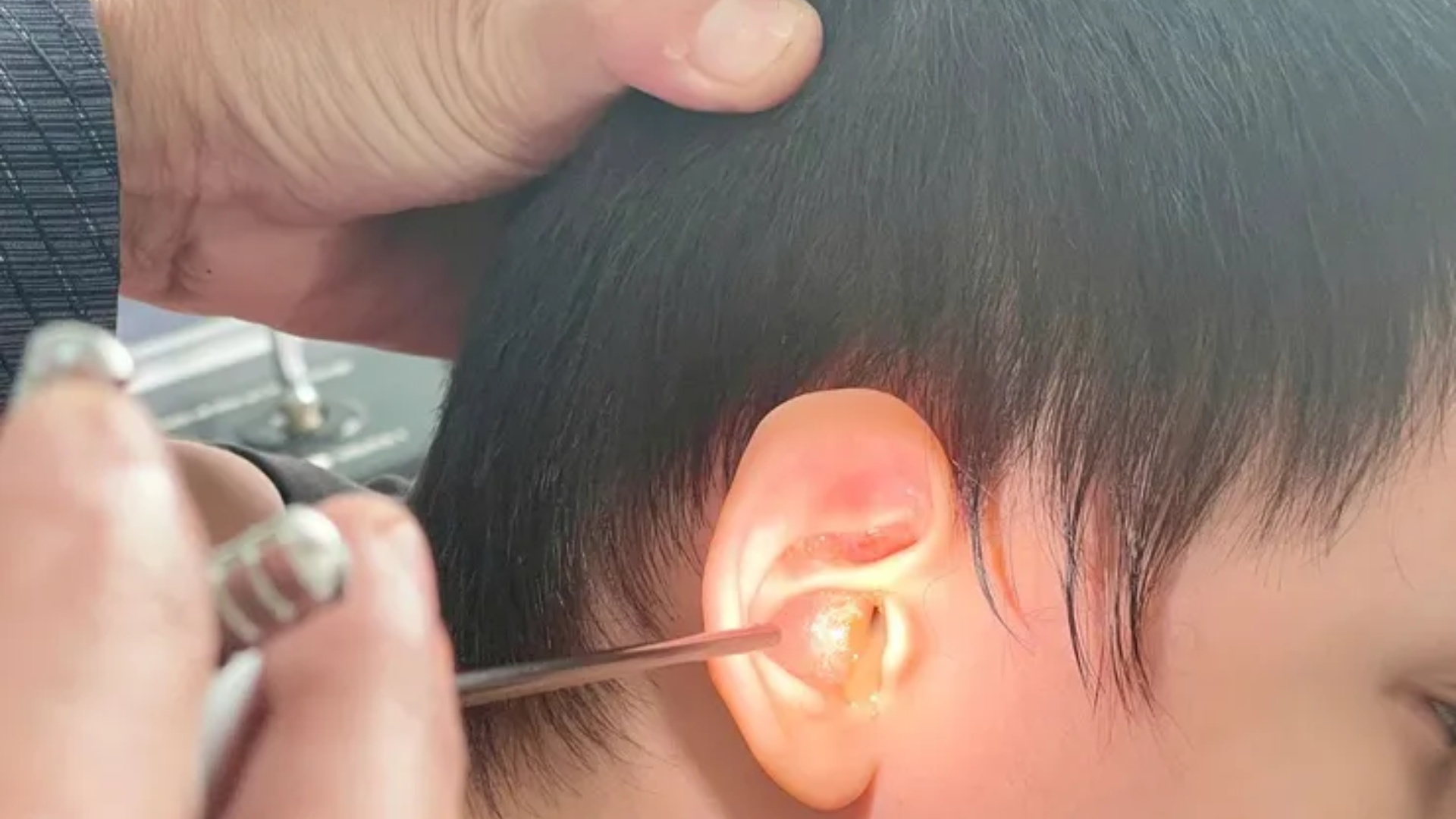 Vệ sinh tai đúng cách khi thủng màng nhĩ giúp ngăn ngừa viêm tai giữa mạn tính và bảo vệ thính lực