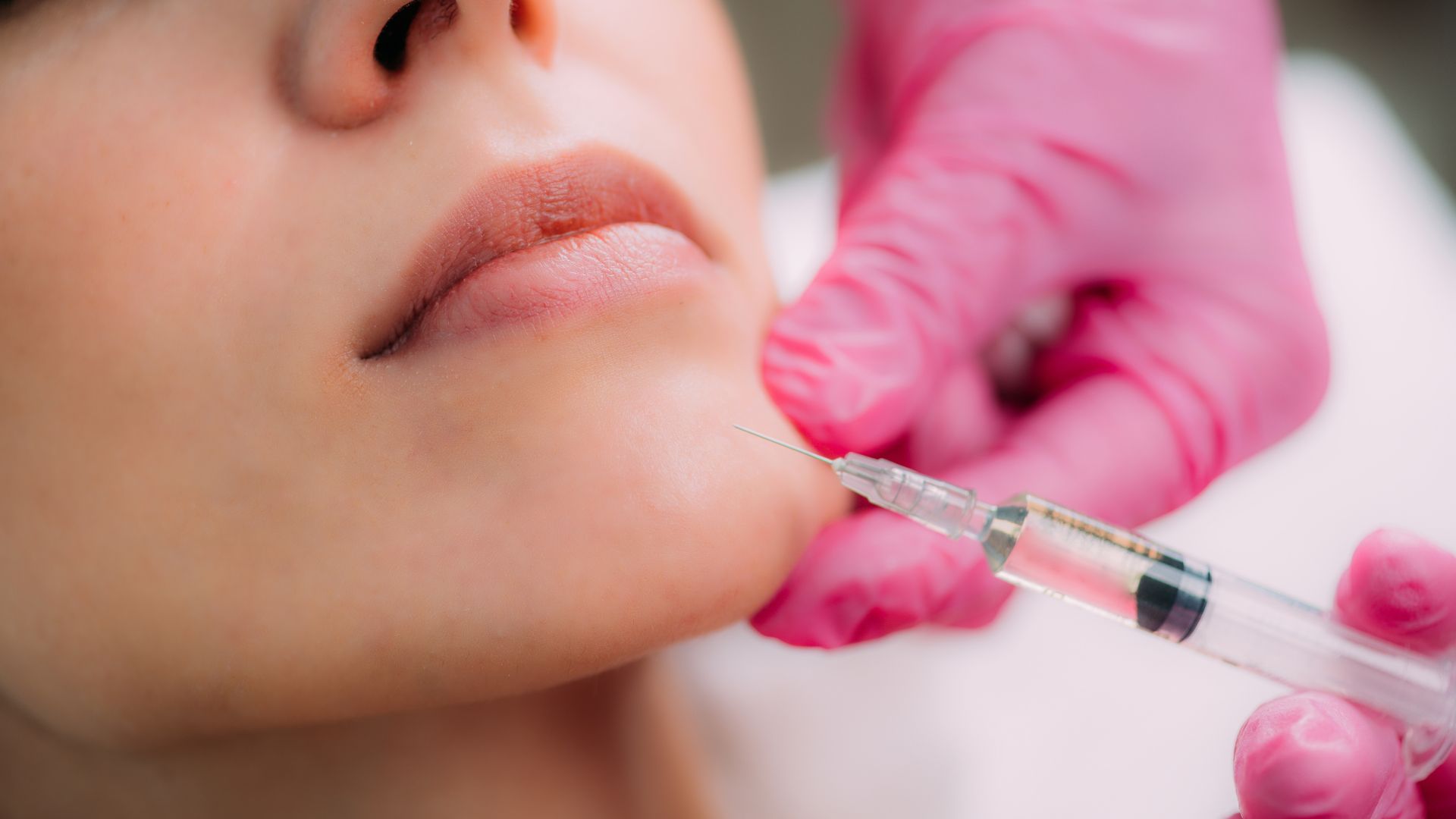Tiêm filler tạo hình cằm nhằm cải thiện cằm bị lẹm