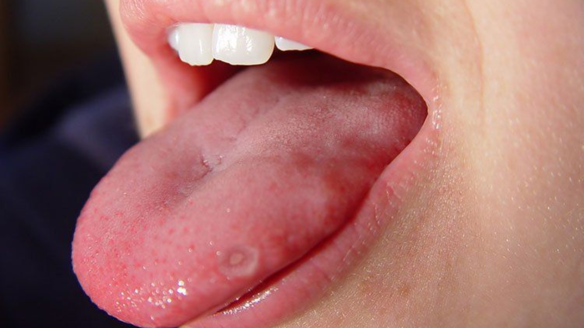 Cắn lưỡi thường xuyên gây đau nhức, viêm loét và ảnh hưởng đến sinh hoạt hàng ngày