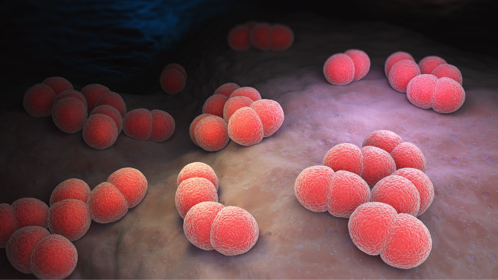 Viêm màng não mô cầu type B do vi khuẩn Neisseria meningitidis nhóm B gây ra