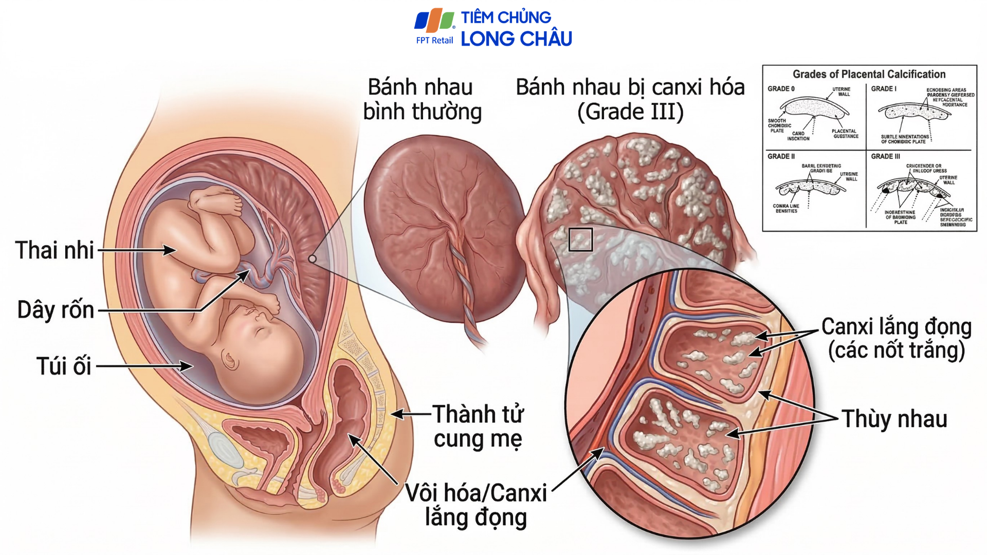 Canxi hoá bánh nhau là hiện tượng lắng đọng canxi trong nhau thai