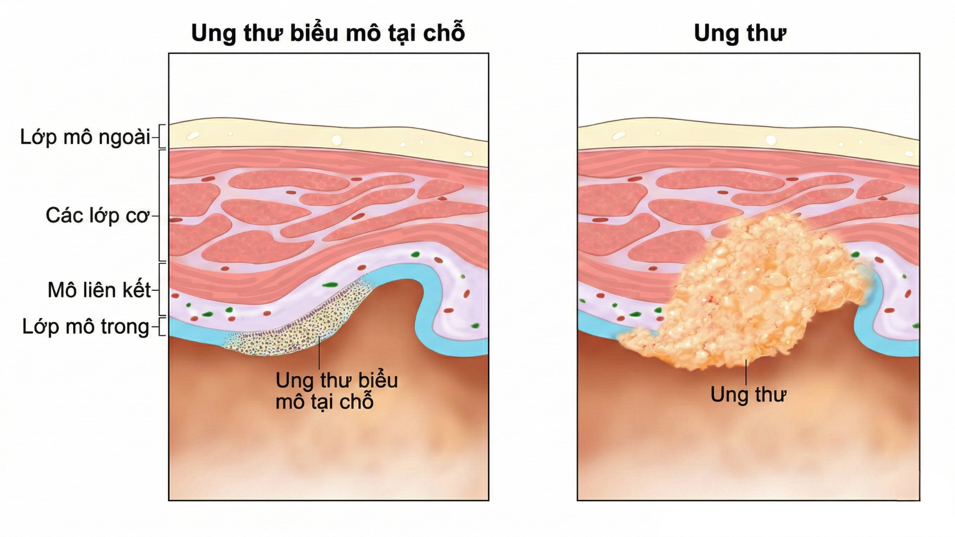 Carcinoma có nguy hiểm không và mức độ rủi ro theo từng giai đoạn bệnh