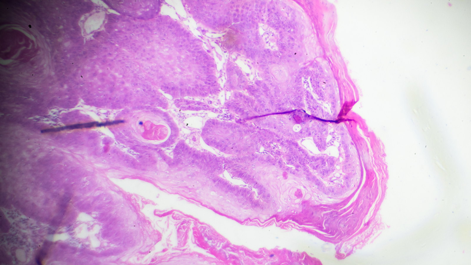 Ung thư carcinoma được chia thành nhiều loại khác nhau