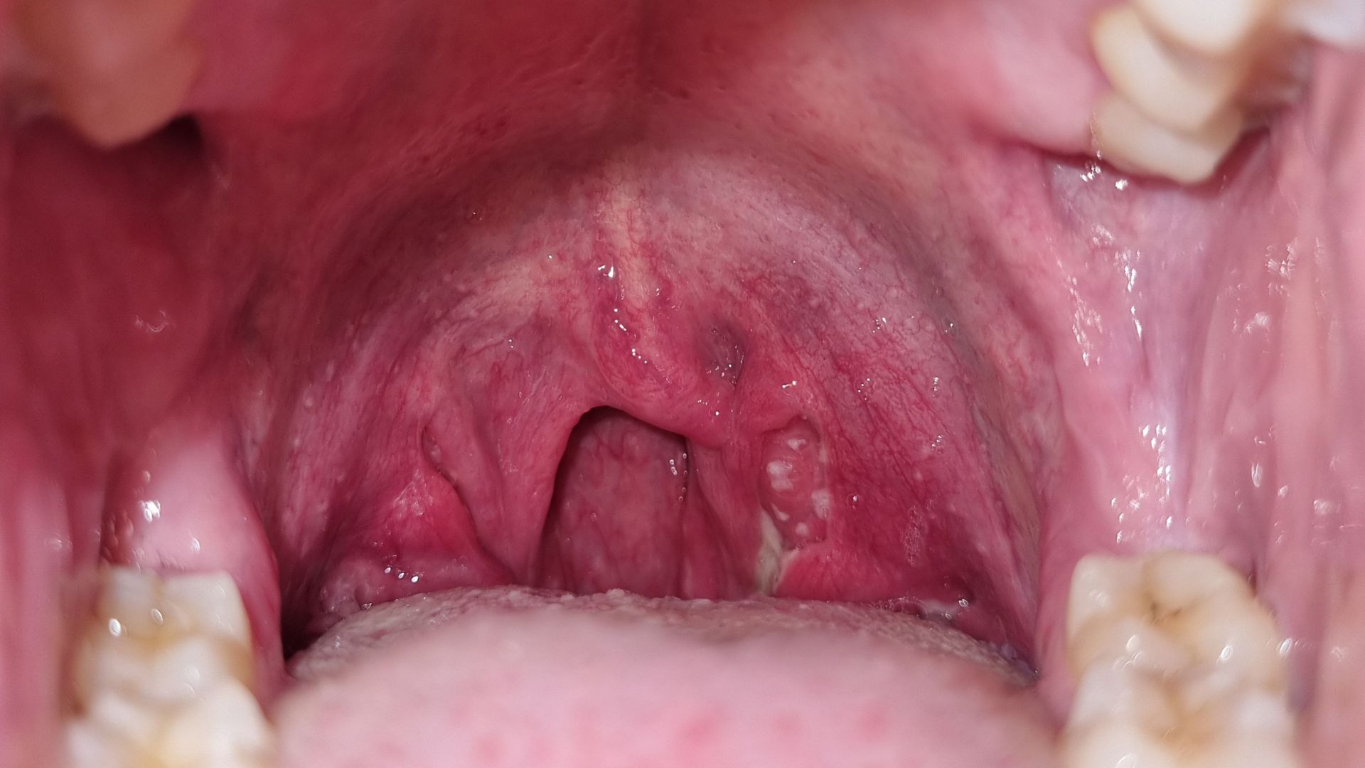 Cắt amidan có hết hôi miệng không phụ thuộc vào việc mùi có thực sự xuất phát từ amidan hay không