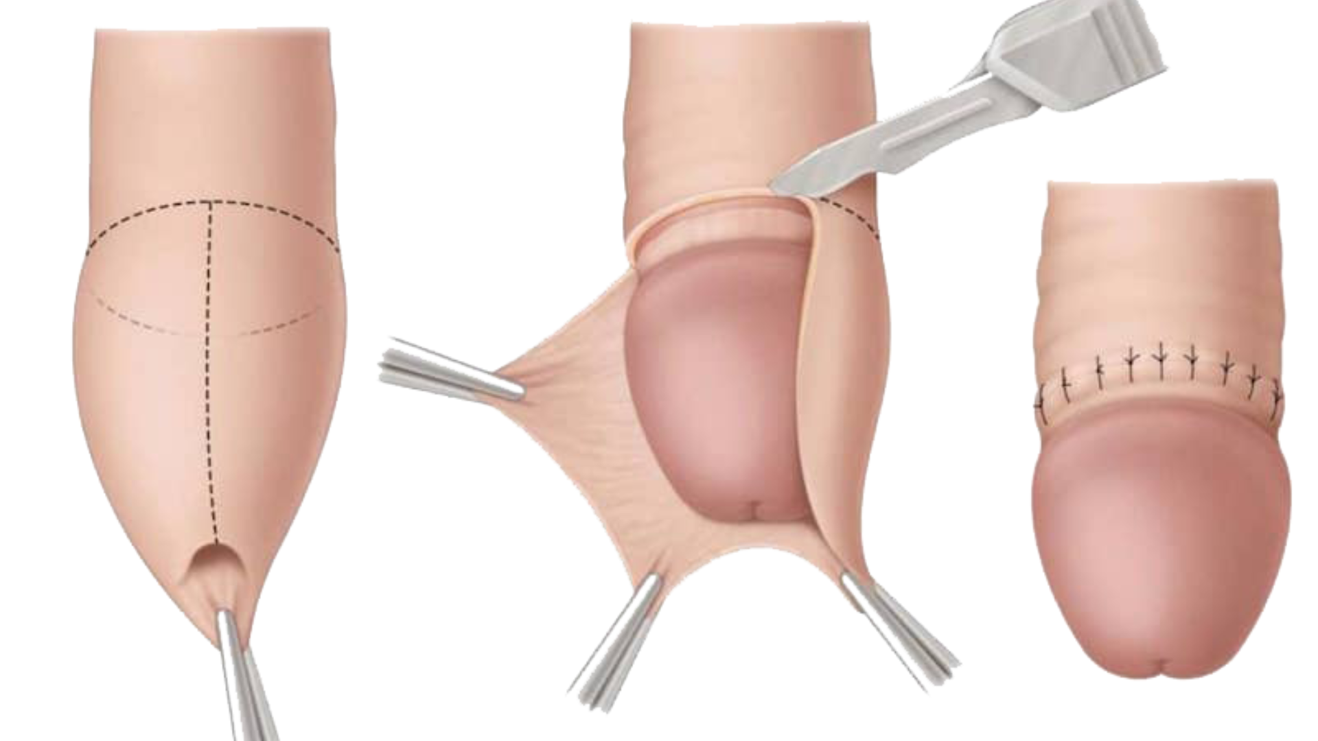 Cắt bao quy đầu là tiểu phẫu đơn giản, thường được thực hiện nhanh chóng