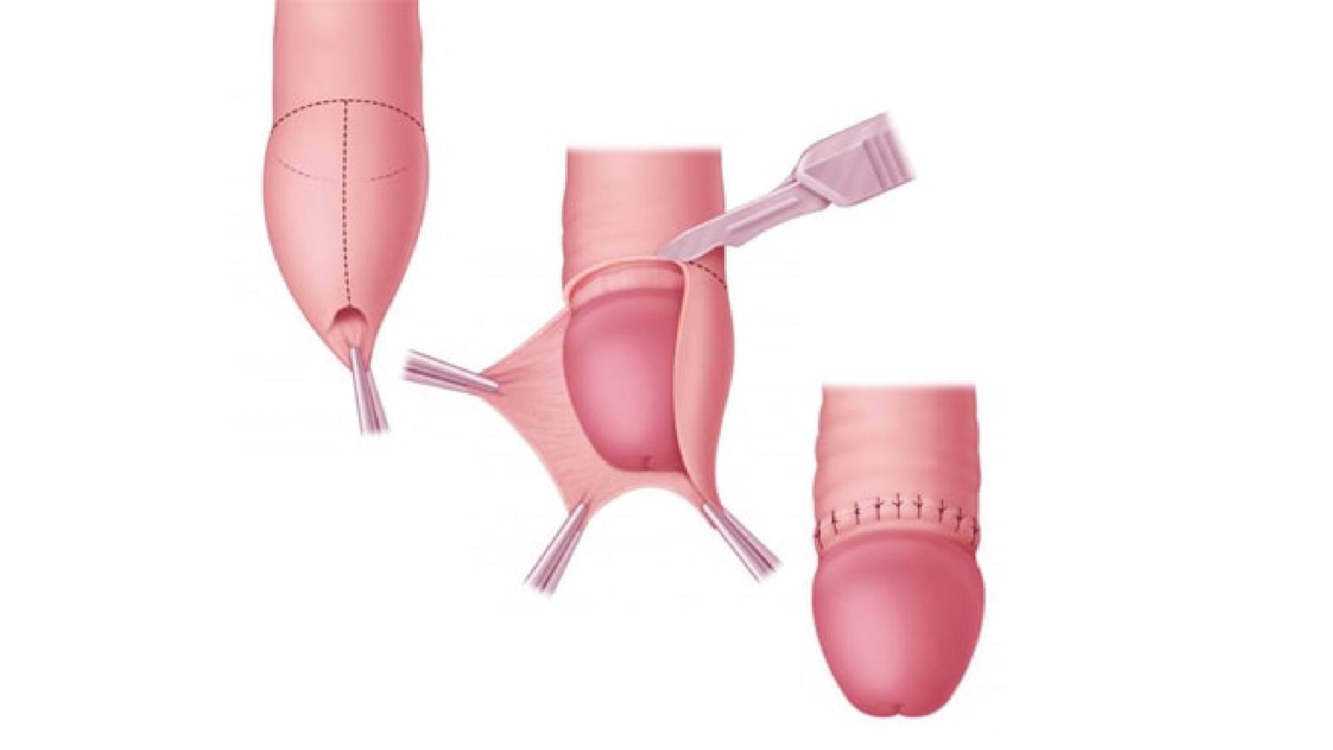 Cắt bao quy đầu là tiểu phẫu tương đối an toàn khi thực hiện tại cơ sở y tế có chuyên môn