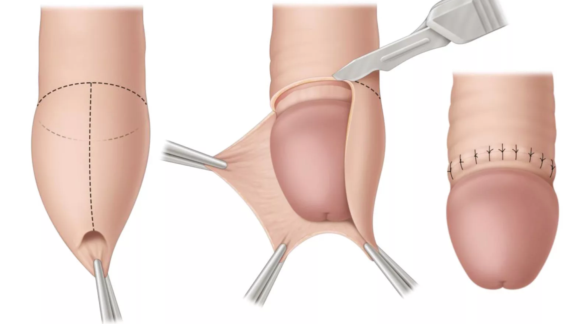 Cắt bao quy đầu sau 10 ngày, vết thương thường chưa lành hẳn mà mới ở giai đoạn hồi phục ban đầu