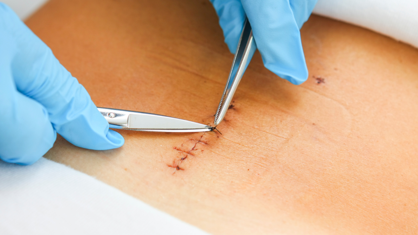 Cắt chỉ xong có được ăn thịt gà không là băn khoăn của nhiều người