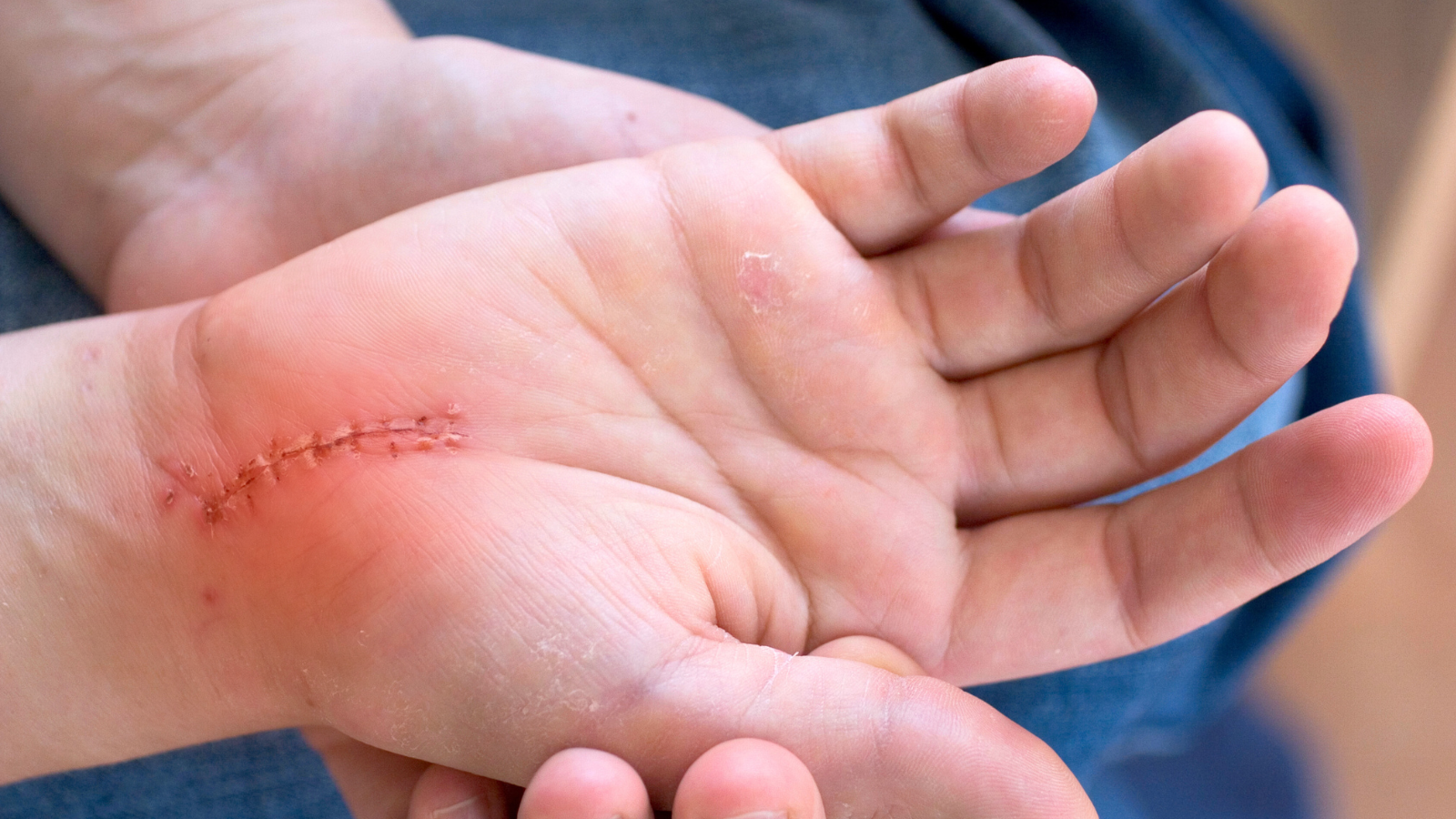 Ở người có cơ địa nhạy cảm, ăn thịt gà quá sớm sau khi cắt chỉ có thể gây ngứa, đỏ hoặc kích ứng