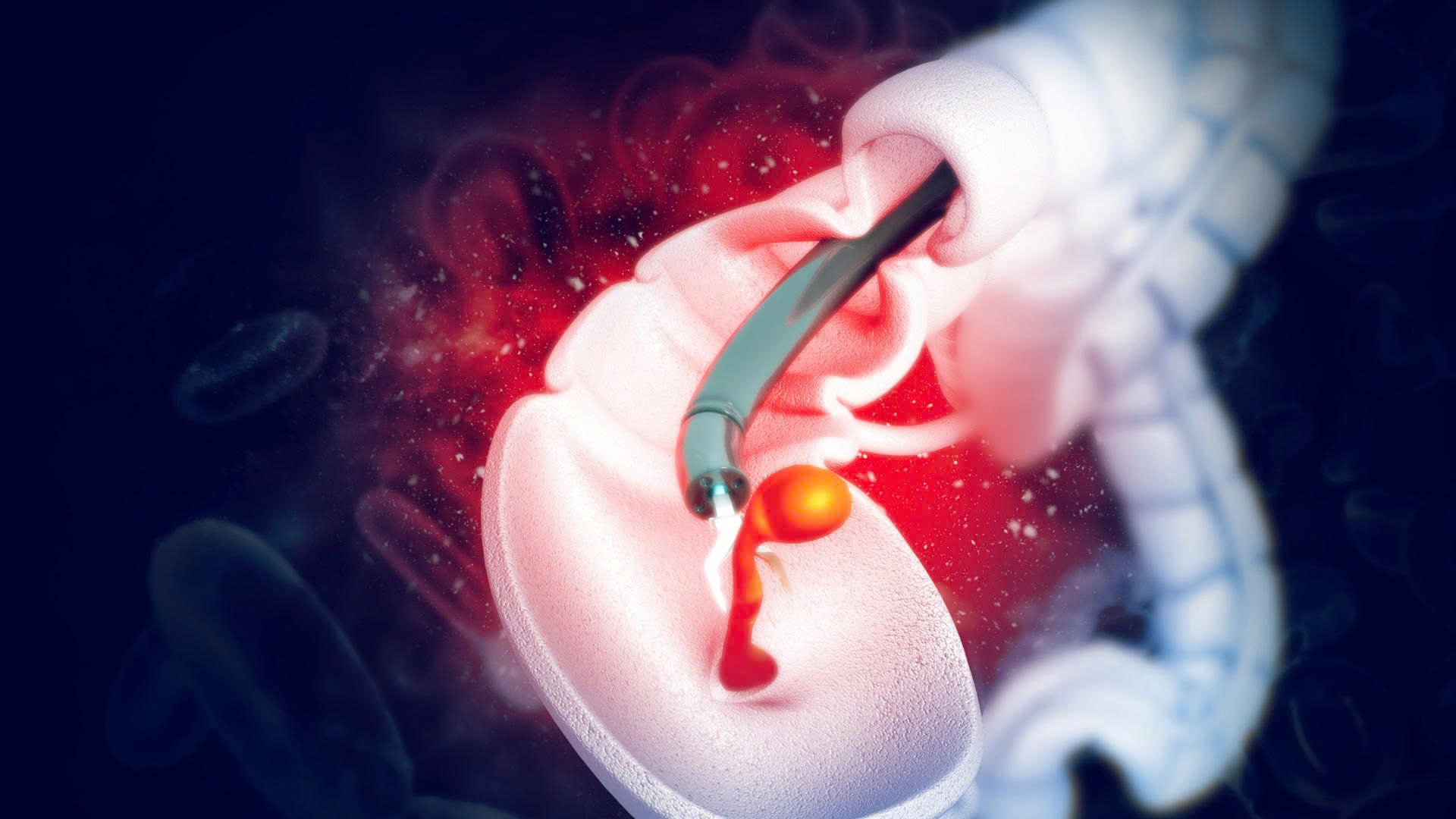 Cắt polyp đại tràng có phải kiêng quan hệ không? Câu trả lời là có vì cơ thể cần thời gian hồi phục