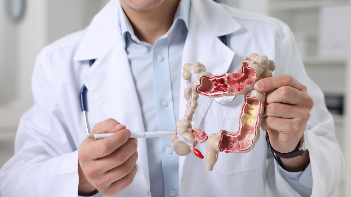 Cắt polyp trực tràng​: Quy trình thực hiện và cách vệ sinh sau khi cắt 1