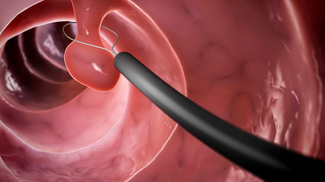 Cắt polyp trực tràng​: Quy trình thực hiện và cách vệ sinh sau khi cắt 3