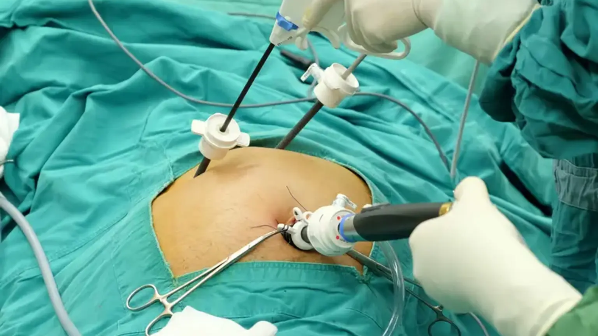 Cắt túi mật nội soi mang lại hiệu quả điều trị an toàn cho người bệnh 1