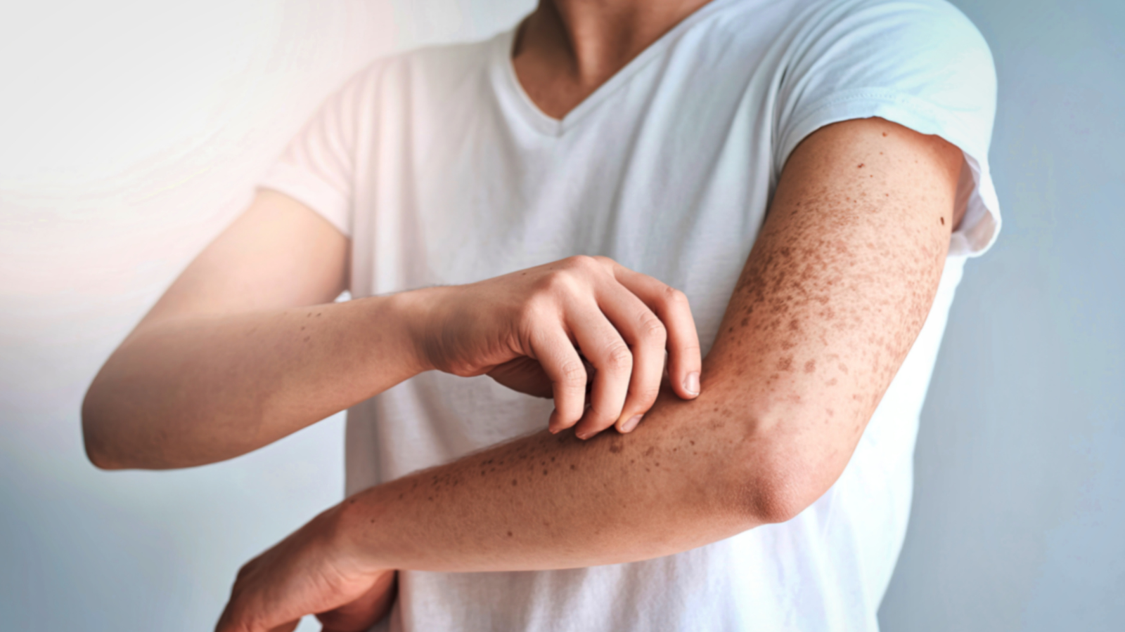 Chàm không lây, nhưng dễ lan rộng nếu bạn tiếp tục gãi