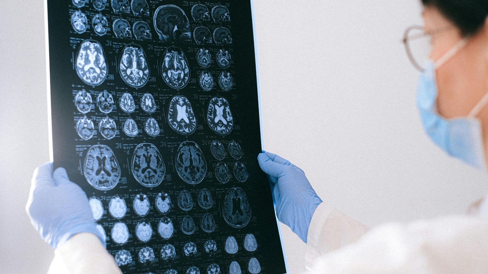 Bệnh chậm phát triển tâm thần có thể kèm bệnh động kinh