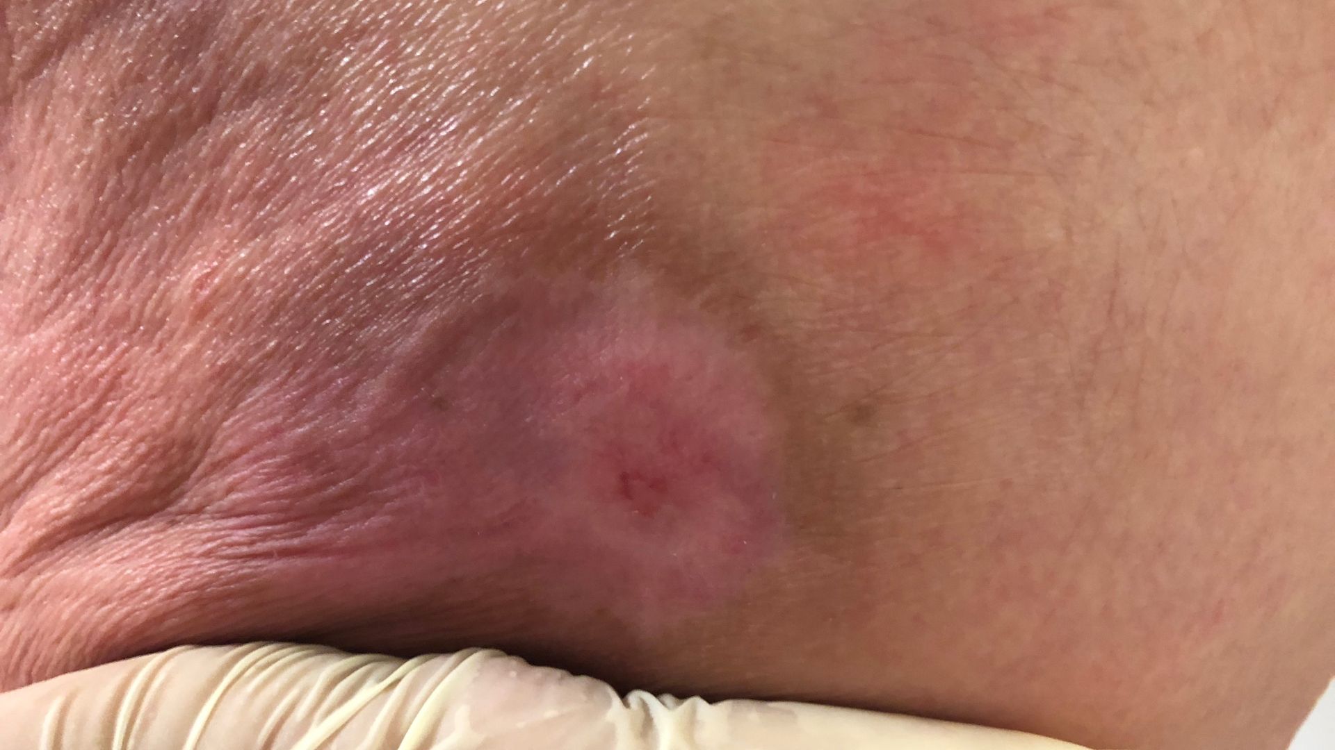 Làm sạch vết loét đúng cách giúp giảm nguy cơ bị nhiễm trùng