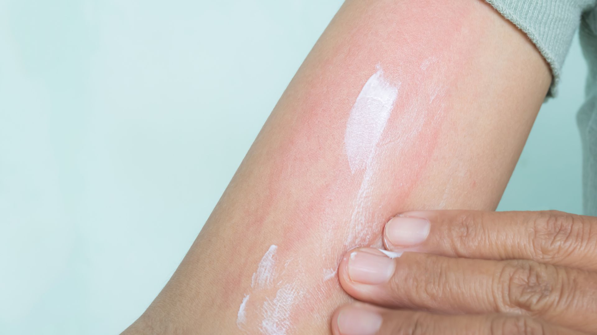 Thời tiết và môi trường có thể làm chàm thể tạng dễ bùng phát và tái phát