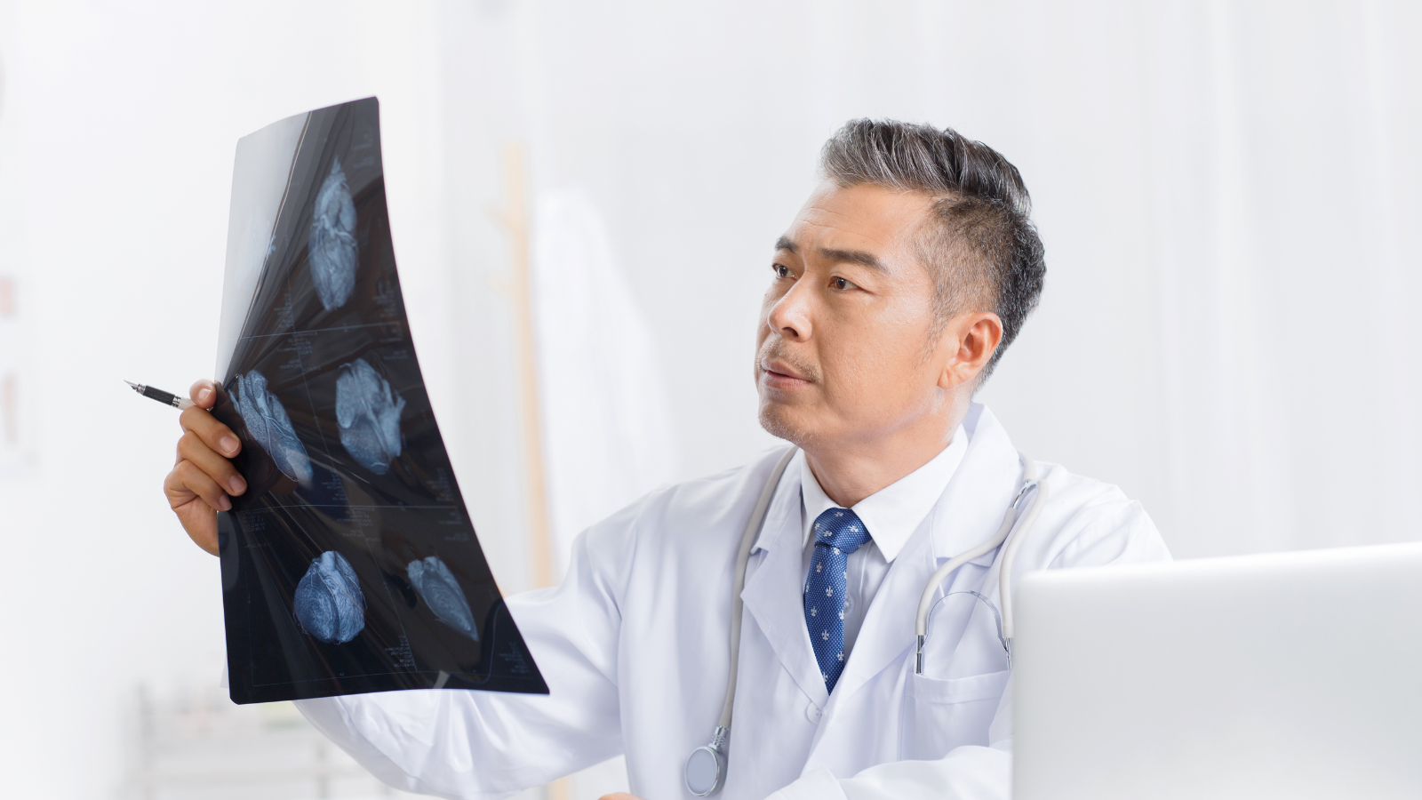 Chẩn đoán hình ảnh là bước quan trọng để xác định mức độ gãy xương sườn số 5 6 7