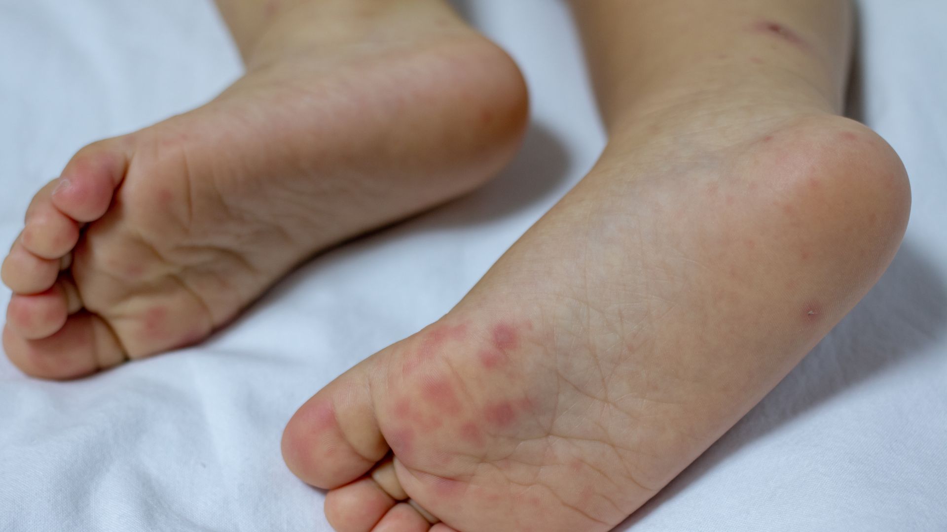 Có thể phân biệt phát ban do tay chân miệng và các bệnh thường gặp khác