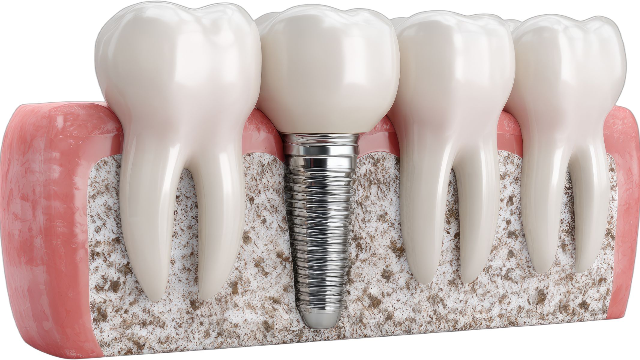 Chân răng là cấu trúc quan trọng giúp cố định răng trong xương ổ răng, đảm bảo chức năng ăn nhai và duy trì sự ổn định của toàn bộ cung hàm