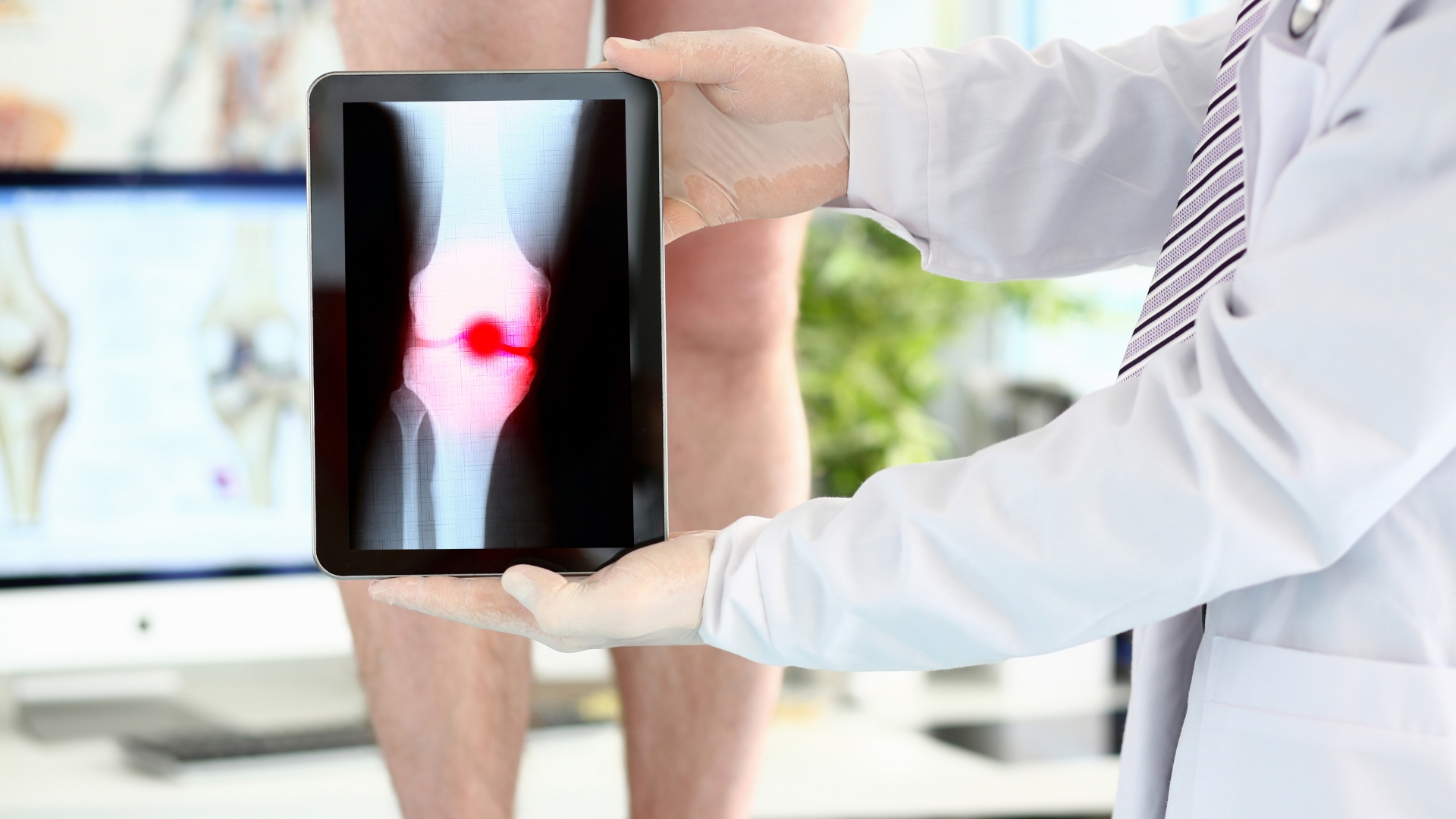 X-quang thường được chỉ định để loại trừ gãy xương hoặc tổn thương xương kèm theo