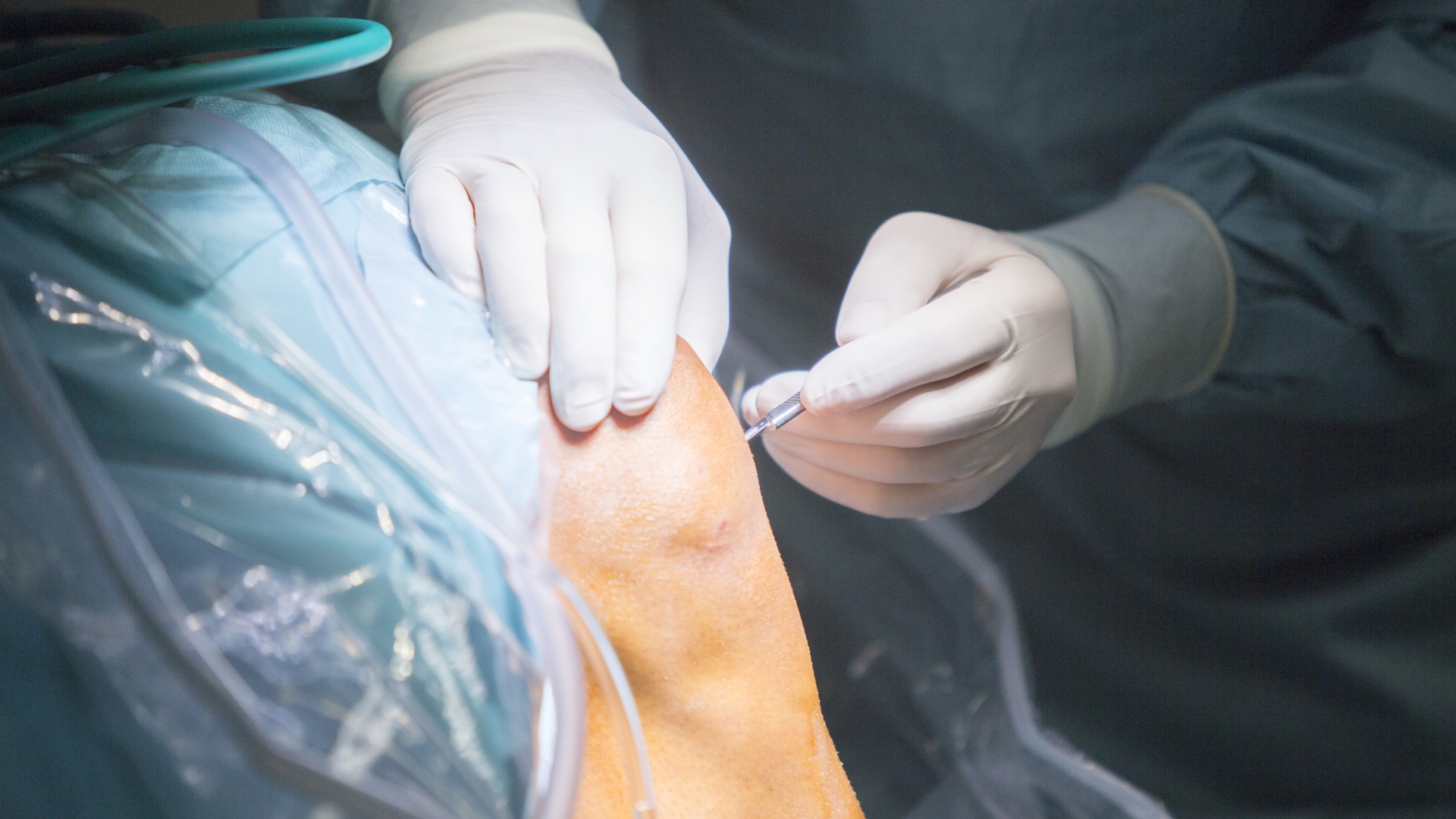 Phẫu thuật được chỉ định trong các trường hợp đứt hoàn toàn, có triệu chứng lỏng khớp gối