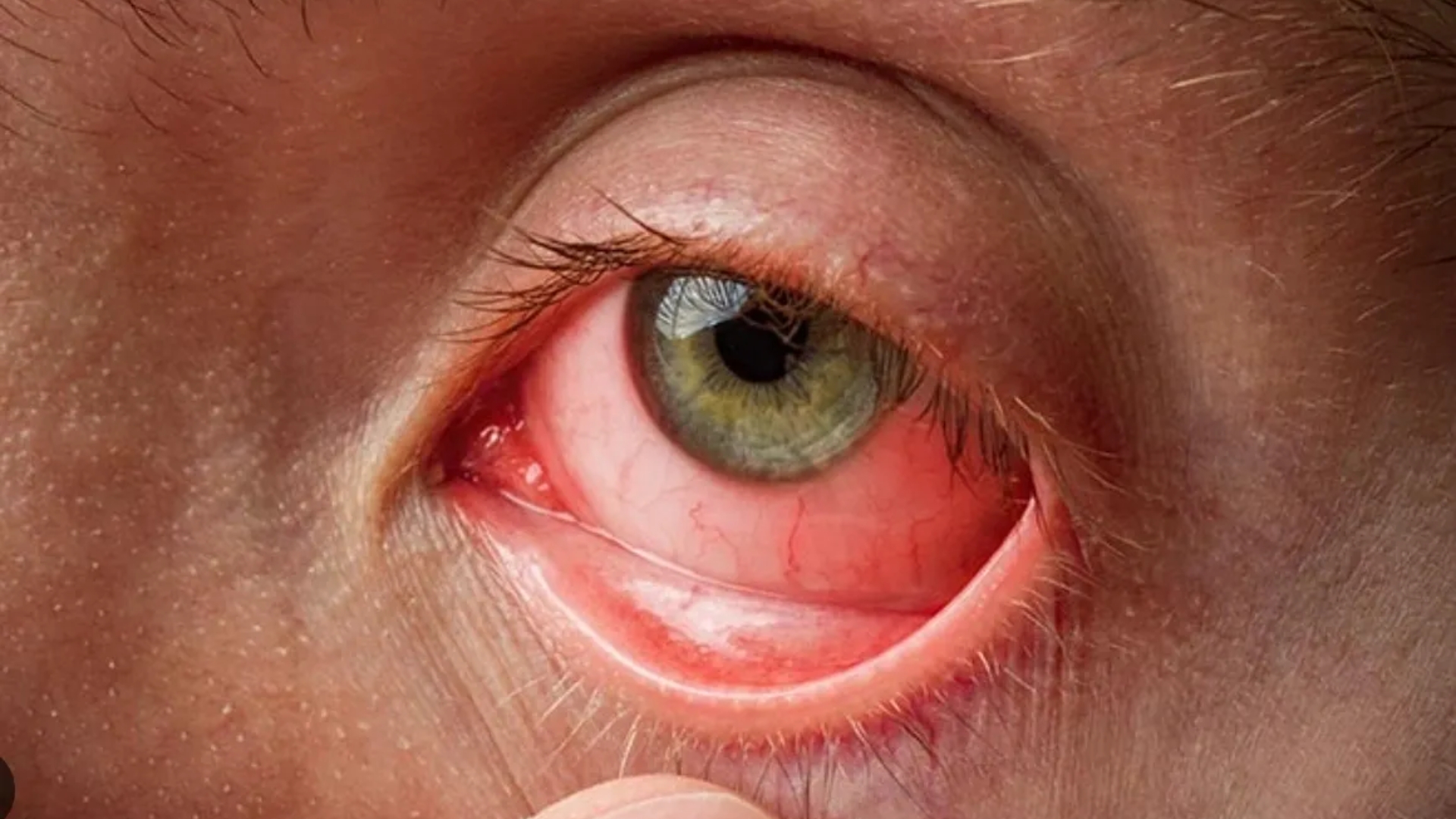 Tình trạng đỏ mắt kéo dài, kèm theo xuất huyết dưới kết mạc là dấu hiệu cho thấy có hiện tượng viêm hoặc xuất huyết sau chấn thương