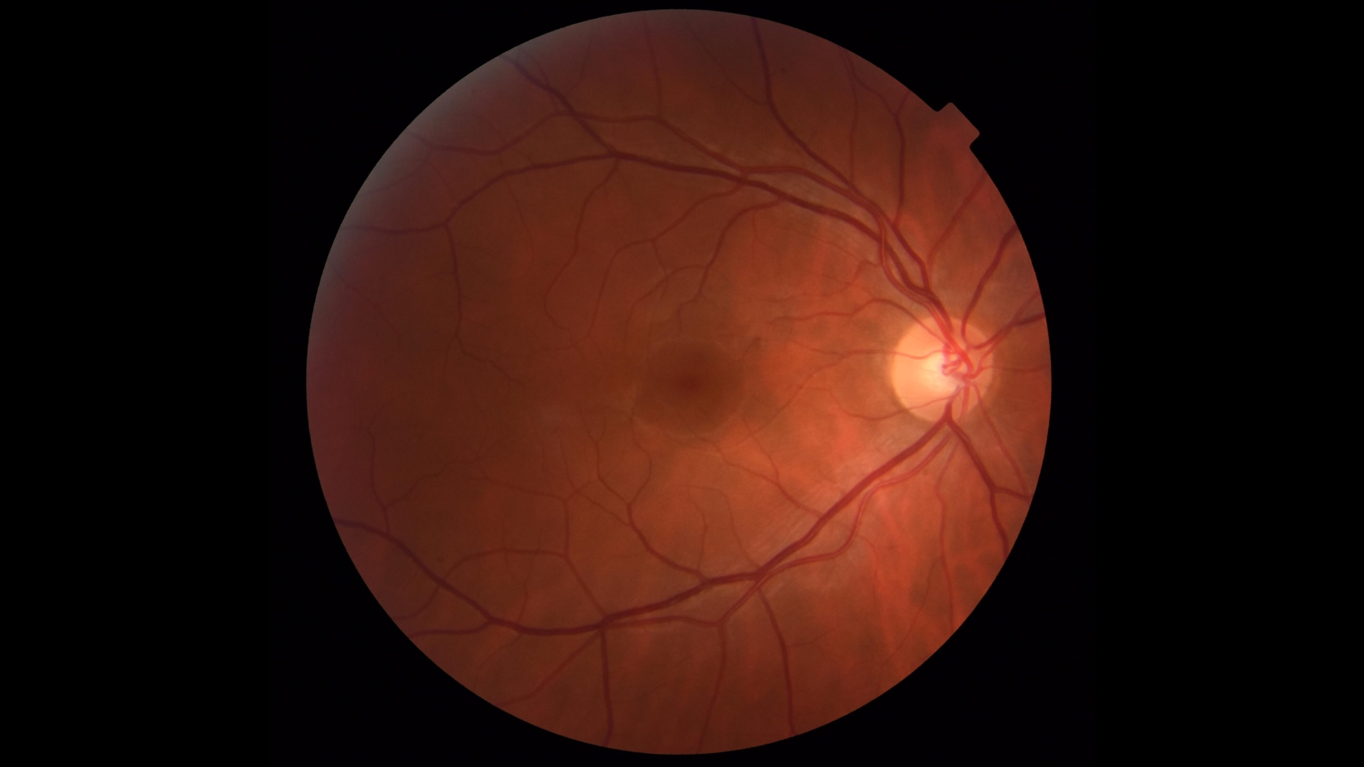 Tùy thuộc vào mức độ và vị trí tổn thương, người bệnh có thể gặp các biến chứng ở giác mạc, nội nhãn, võng mạc, thần kinh thị giác,...