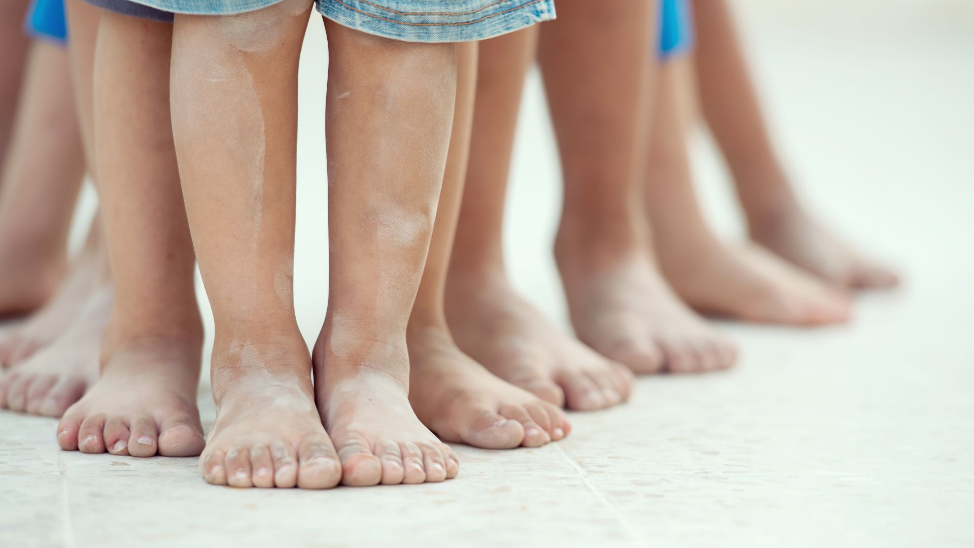 Chân vòng kiềng ở trẻ là tình trạng hai chân cong ra ngoài khi đứng