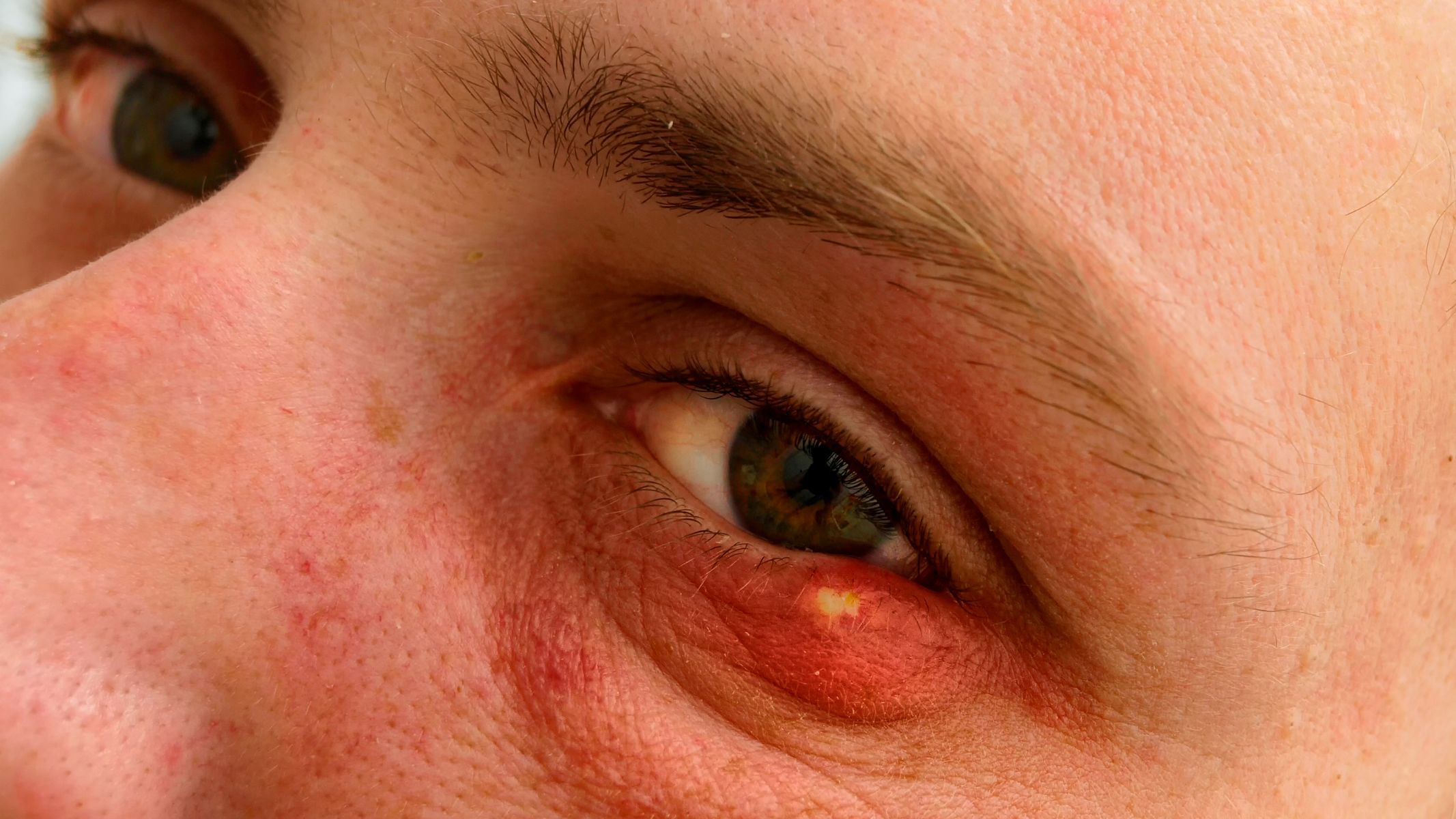 Chắp mắt bị vỡ có nguy hiểm không?