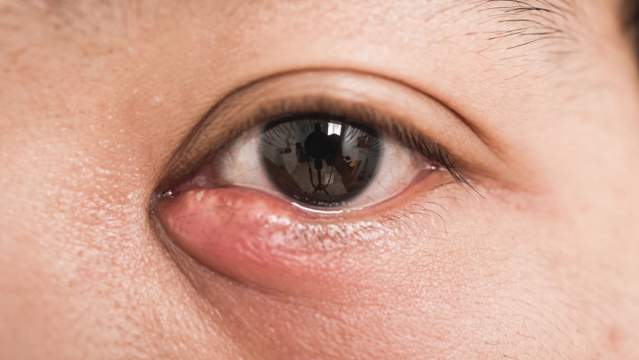 Chắp mắt bao lâu thì khỏi?