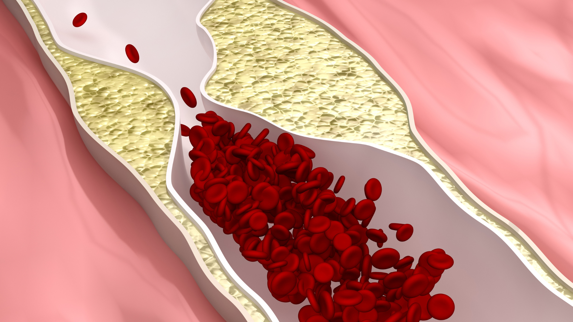 Sử dụng quá nhiều chất béo bão hòa có nguy cơ mắc xơ vữa động mạch