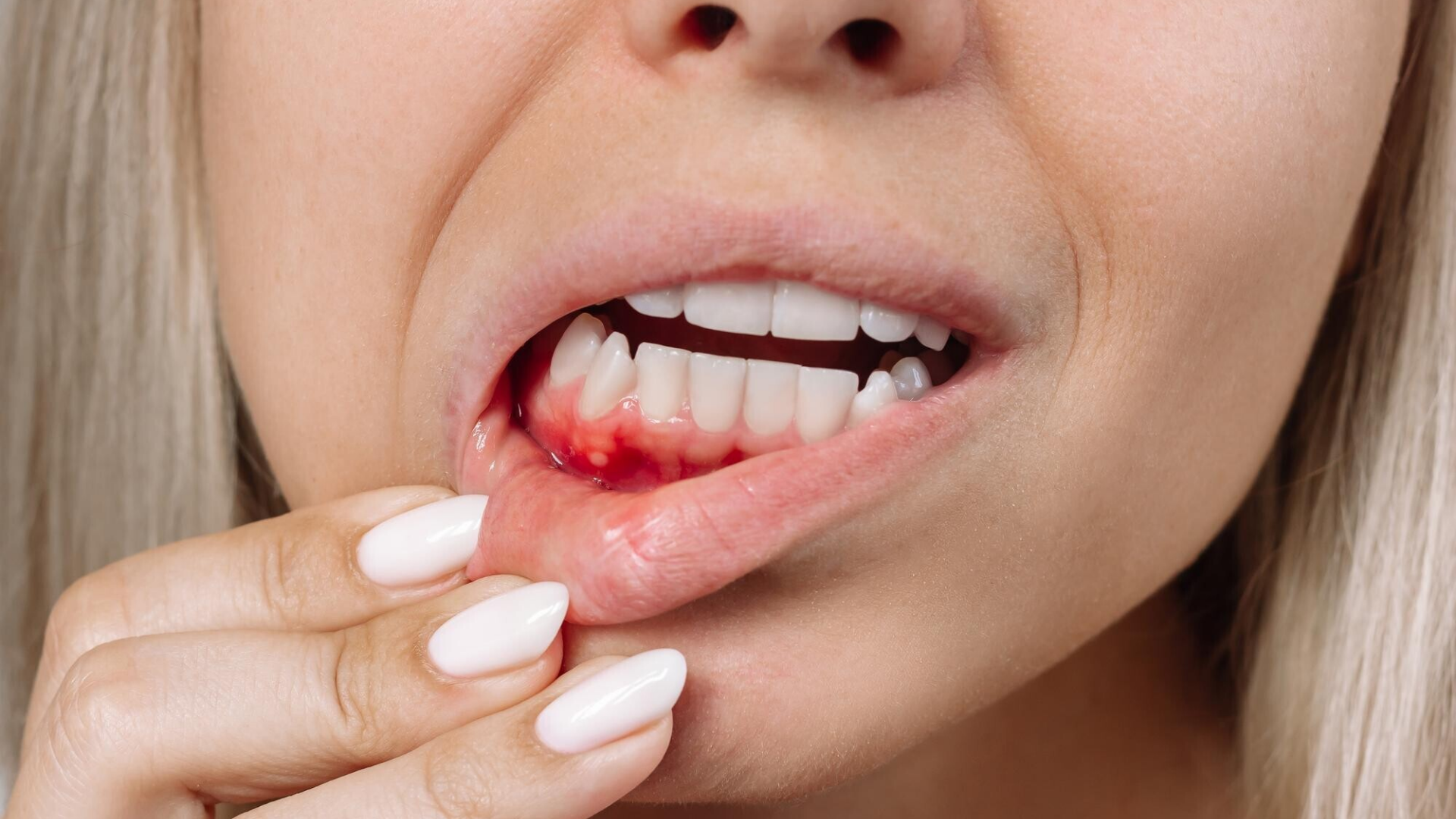 Chảy máu chân răng ung thư đi kèm các triệu chứng nổi hạch, mệt mỏi