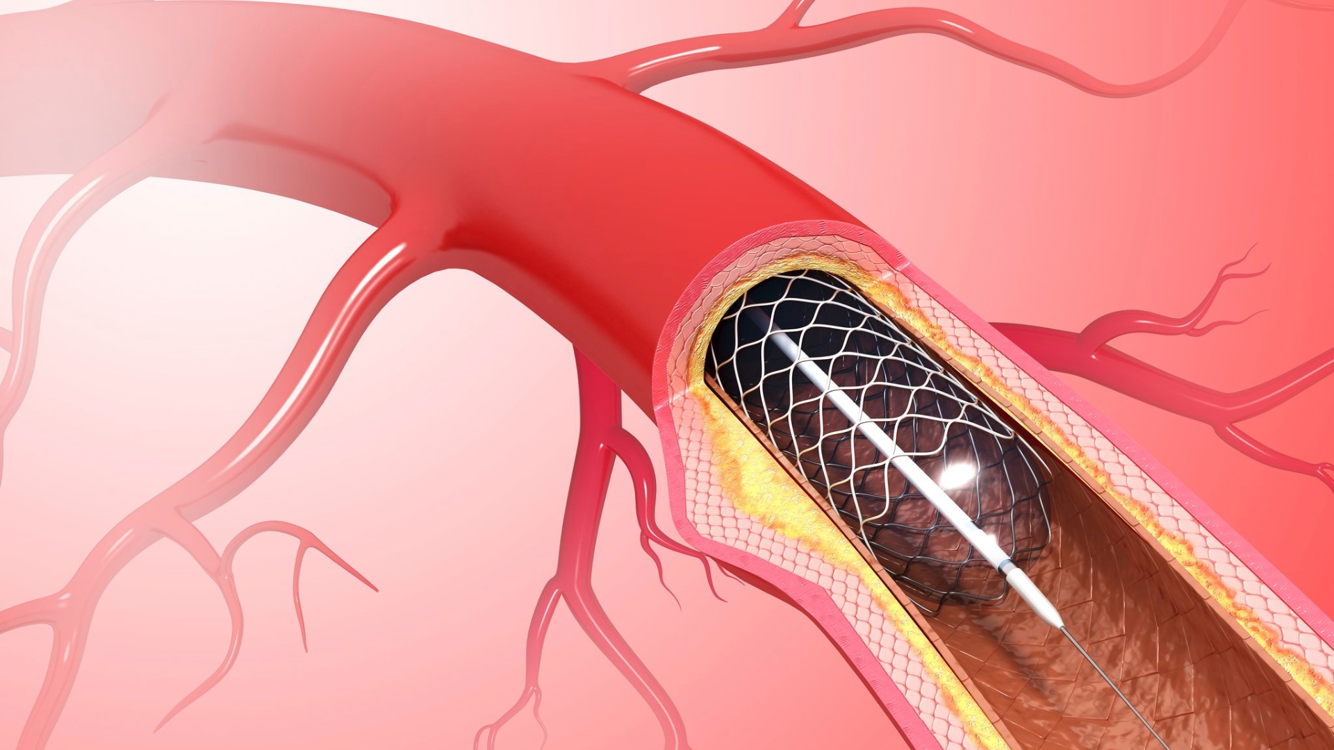 Stent mạch máu não đóng vai trò duy trì lưu thông máu ổn định, giúp giảm nguy cơ đột quỵ và tổn thương tế bào não