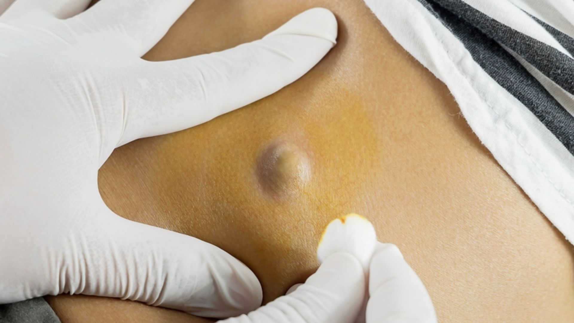 Vị trí và kích thước u bã đậu ảnh hưởng đến chi phí mổ u bã đậu