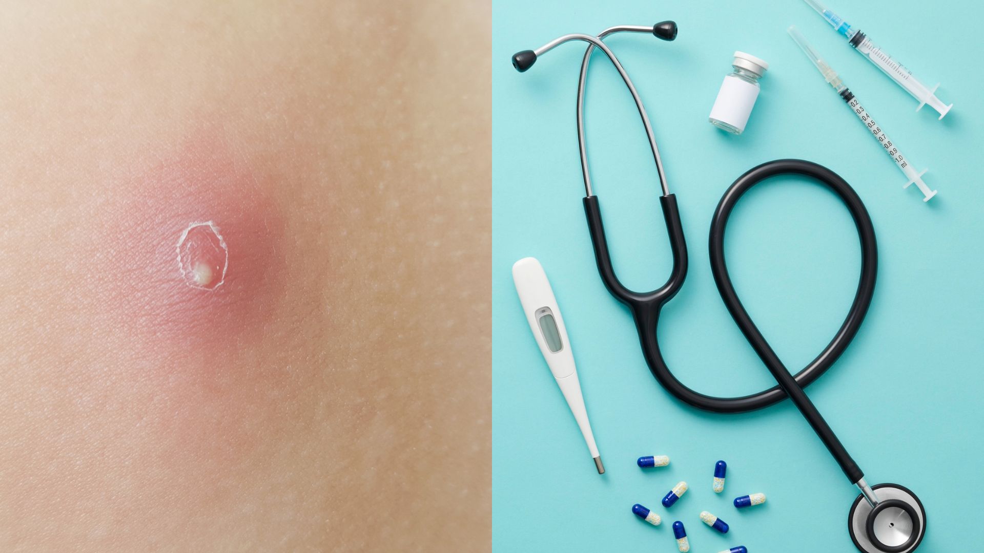 Phương pháp xử trí u bã đậu cũng là một yếu tố chi phối giá mổ u bã đậu