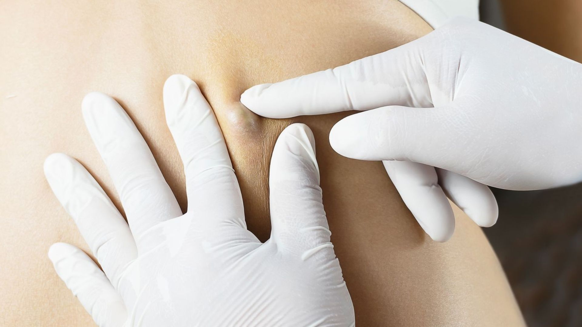 Chi phí mổ u bã đậu thường bao gồm phí khám ban đầu và chi phí mổ