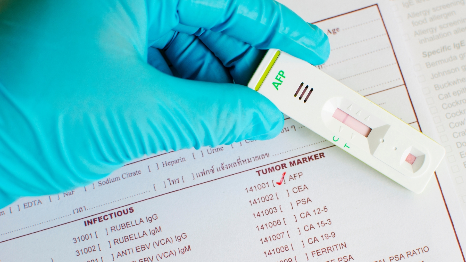 Mức AFP tăng cao, đặc biệt khi vượt quá 400 ng/mL, thường liên quan đến ung thư gan nguyên phát