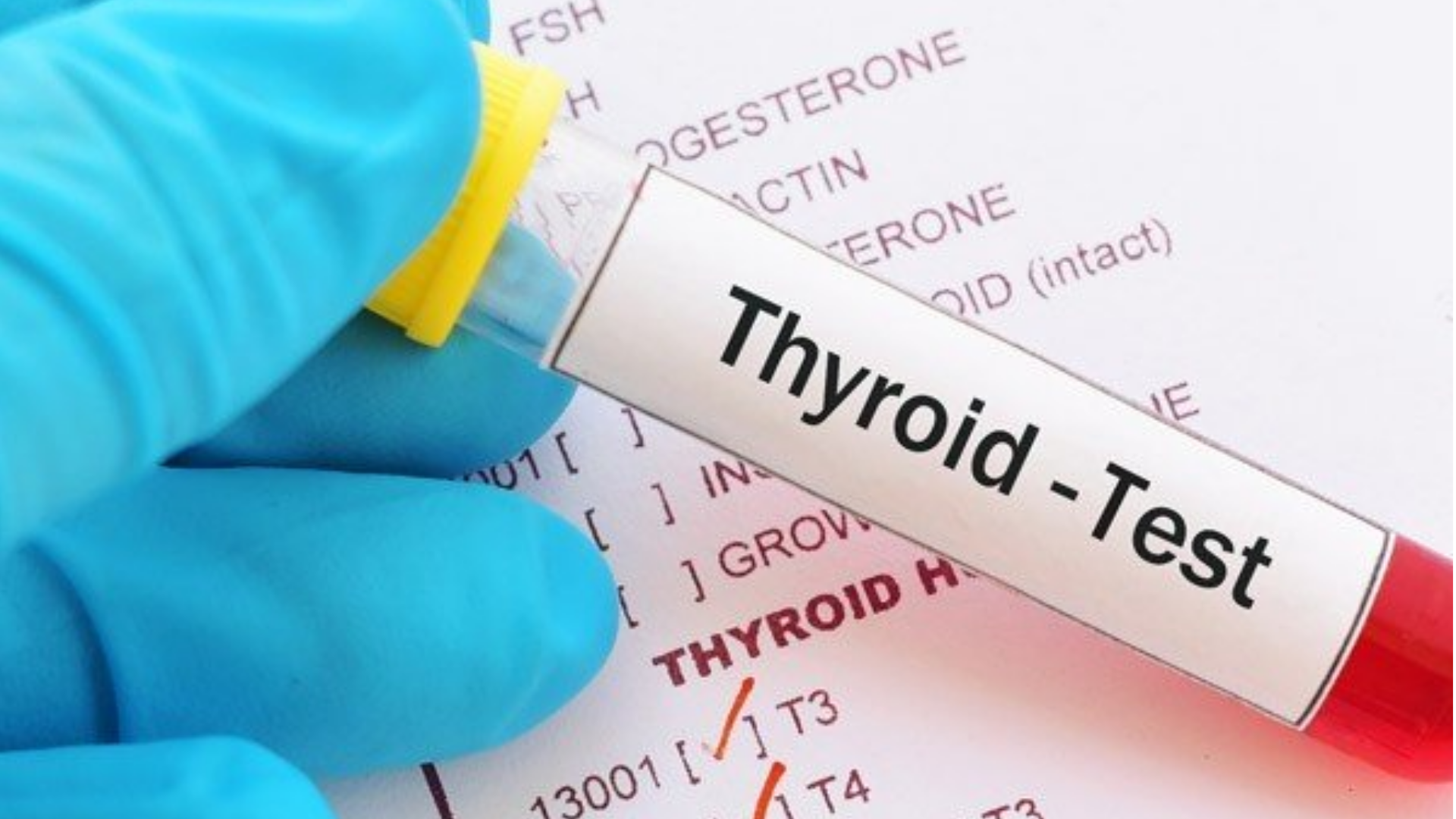 Người bệnh không nên quá lo lắng khi thấy chỉ số Anti TG tăng mà chưa có kết luận từ bác sĩ chuyên khoa nội tiết