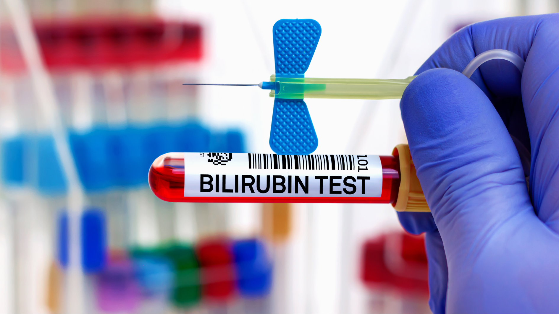 Chỉ số bilirubin trực tiếp có ý nghĩa gì trong chẩn đoán bệnh? 5